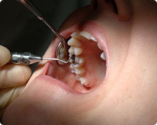 むし歯の治療 イメージ画像