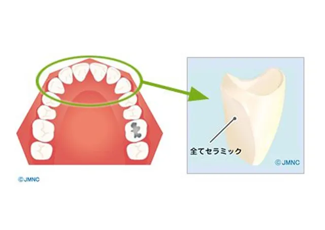 オールセラミッククラウン