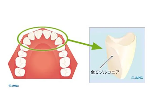 ジルコニアクラウン