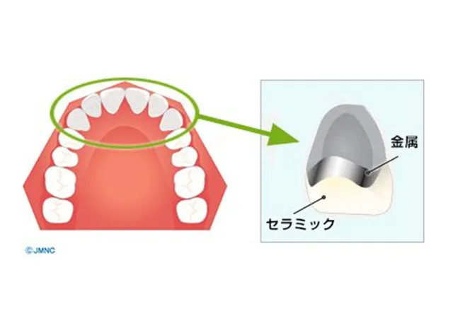 メタルボンドクラウン