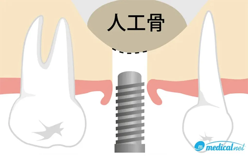 ソケットリフト法（上顎洞底拳上術）
