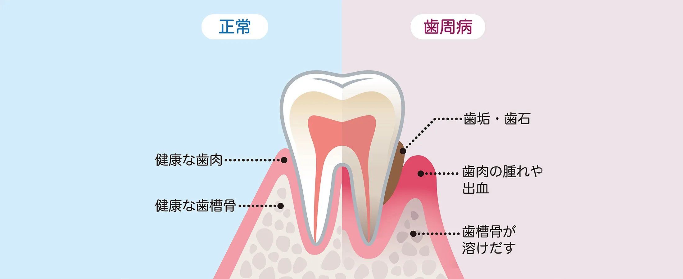 歯周病とは